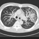 endobronchial tuberculosis ct